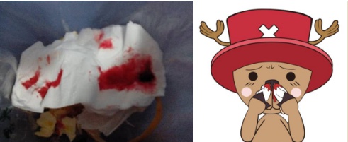 連續服用威而鋼後流鼻血